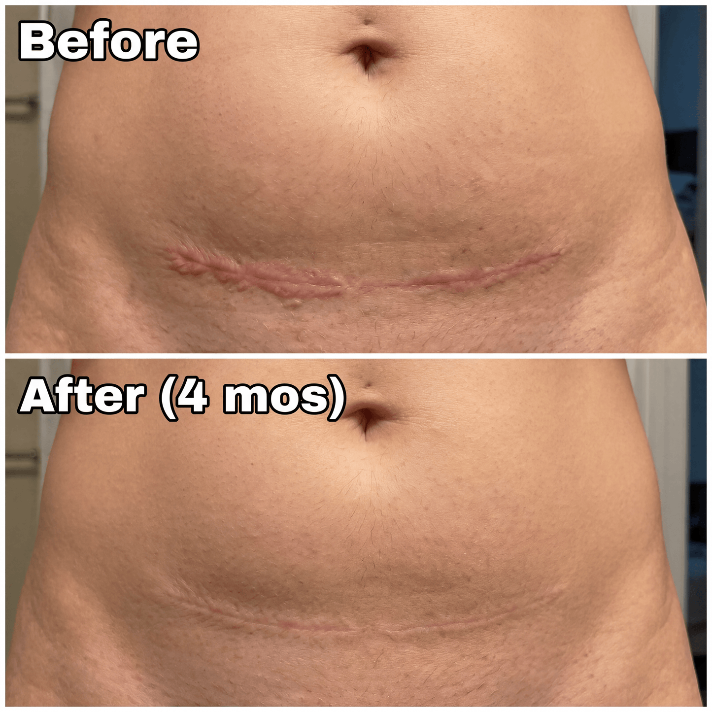 Novexa™ Scar & Wrinkle Stick Silicone Treatment for Face & Body