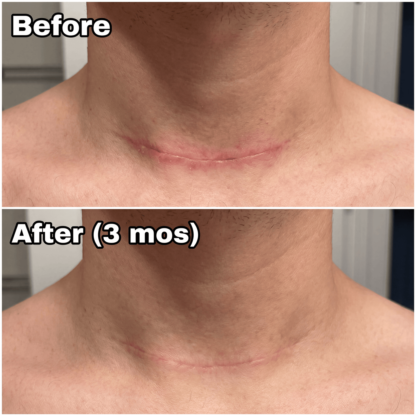 Novexa™ Scar & Wrinkle Stick Silicone Treatment for Face & Body