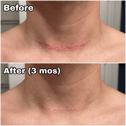 Novexa™ Scar & Wrinkle Stick Silicone Treatment for Face & Body