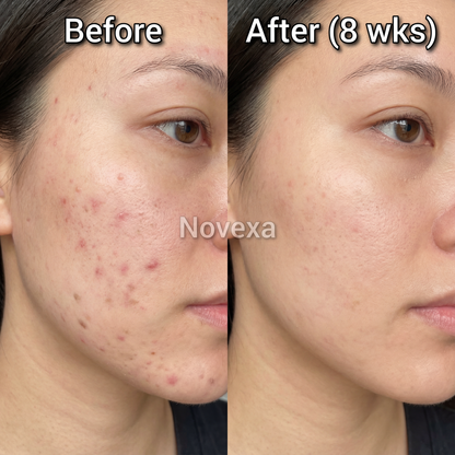 Novexa™ Scar & Wrinkle Stick Silicone Treatment for Face & Body