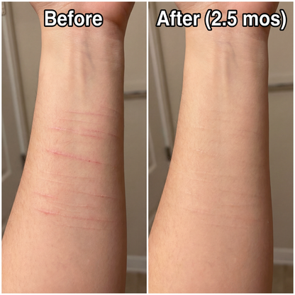 Novexa™ Scar & Wrinkle Stick Silicone Treatment for Face & Body