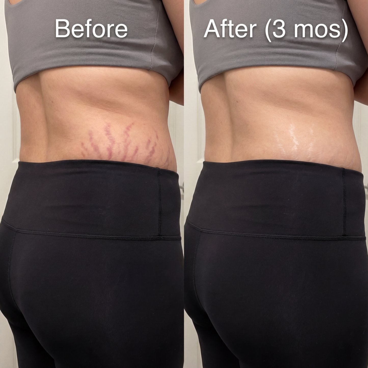 Novexa™ Scar & Wrinkle Stick Silicone Treatment for Face & Body