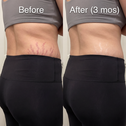 Novexa™ Scar & Wrinkle Stick Silicone Treatment for Face & Body